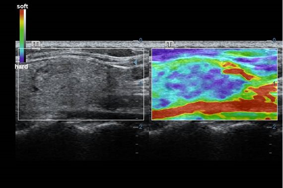 Natural touch elastography of thyroid mass